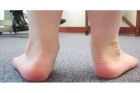 Лечение плоско вальгусной стопы у ребенка