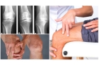 Лечение остеоартроза коленного сустава