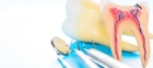 Лечение периодонтитов без каналов ( в т.ч.  кариес депульпированного зуба)