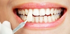 Терапевтический винир без стоимости лечения зуба и пломбы