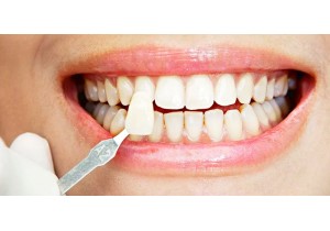 Терапевтический винир без стоимости лечения зуба и пломбы